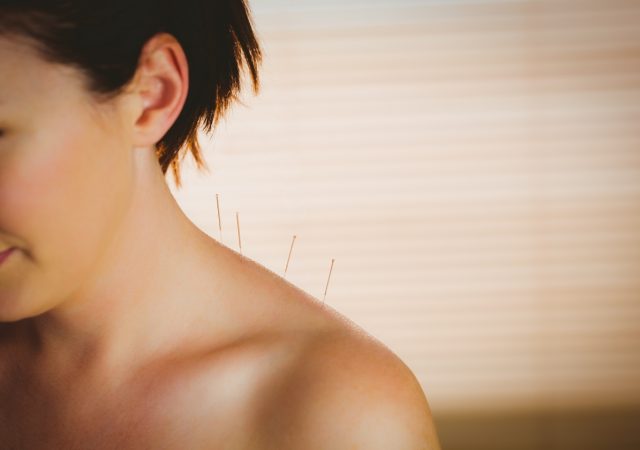 Young woman getting acupuncture treatment in therapy room